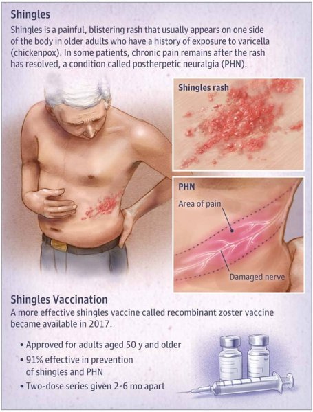 vaccine rash