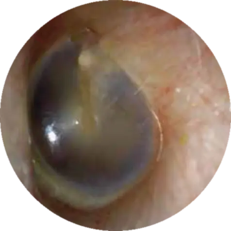 Clear, healthy ear canal after microsuction