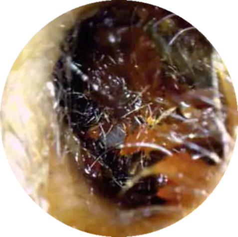Ear canal blocked with earwax before microsuction