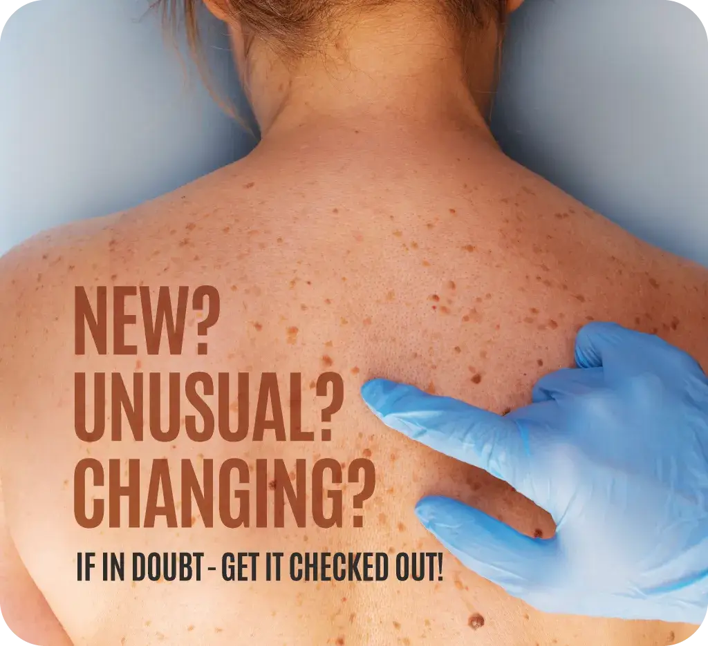 If in doubt, get it checked out — mole and melanoma awareness
